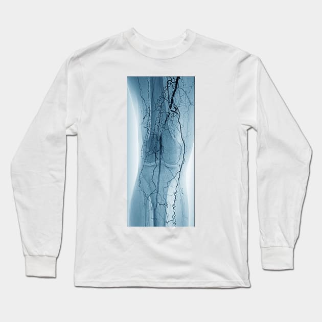 Peripheral vascular disease in diabetes (C029/9941) Long Sleeve T-Shirt by SciencePhoto